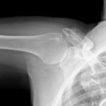 Brutet nyckelben – orsak, symtom & behandling